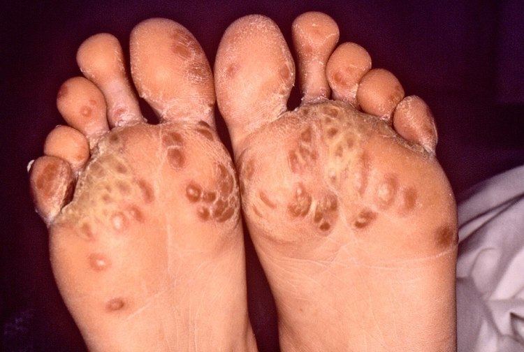 Keratoderma blennorrhagicum