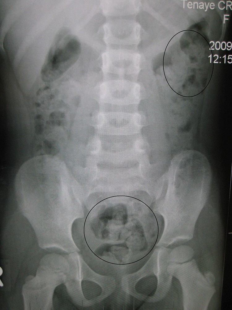 Kidneys, ureters, and bladder x-ray