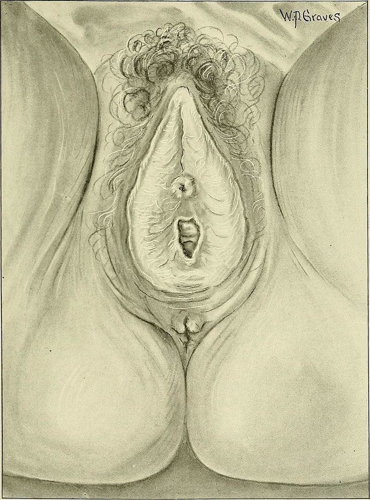 Kraurosis vulvae