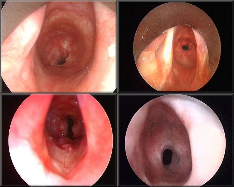 Laryngotracheal stenosis