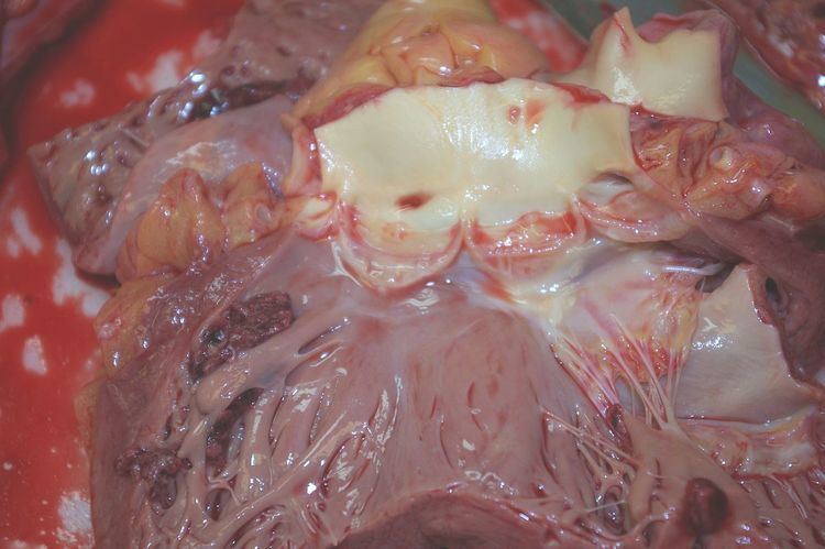 Left ventricular thrombus