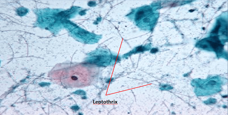 Leptothrix CervixCytology Leptothrix vaginalis