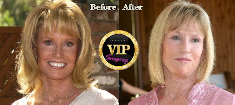 Leslie Charleson Leslie Charleson Plastic Surgery Before and After Photos