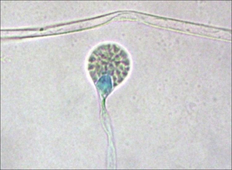 Lichtheimia corymbifera A case of otomycosis caused by Lichtheimia corymbifera syn Absidia