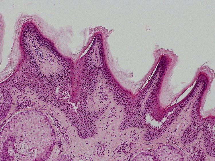 Linear verrucous epidermal nevus