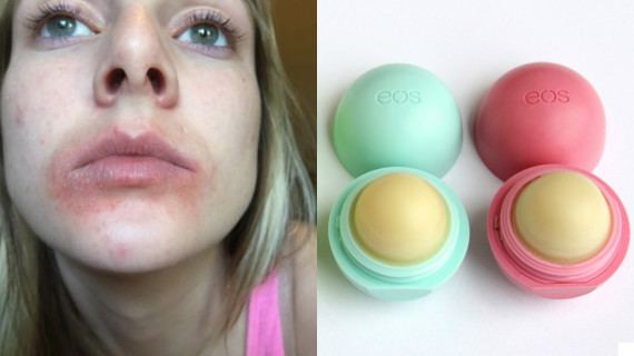 Lip balm Is This Lip Balm Really Causing Rashes What To Know About the