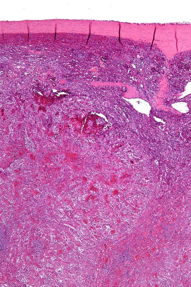 Littoral cell angioma