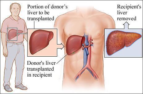 Liver transplantation 1000 images about Liver transplant on Pinterest Handmade sterling