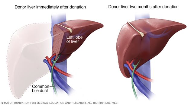 Liver transplantation Liver transplant What you can expect Mayo Clinic