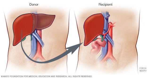 Liver transplantation Liver transplant What you can expect Mayo Clinic