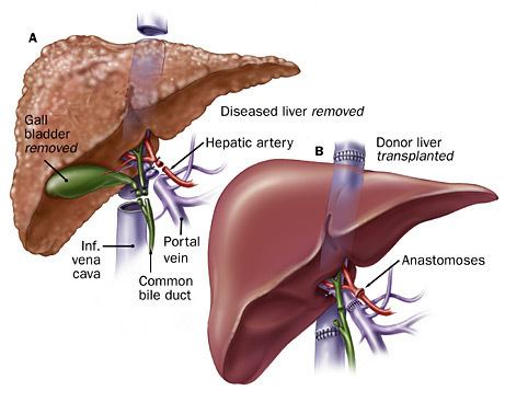 Liver transplantation Liver Transplantation Hospitals in Hyderabad India CARE Hospitals