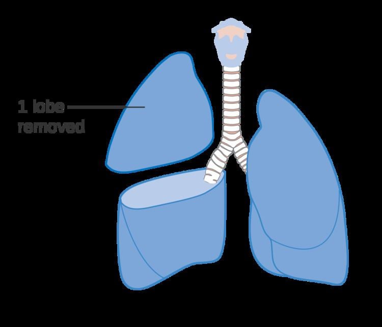 Lobectomy (lung)