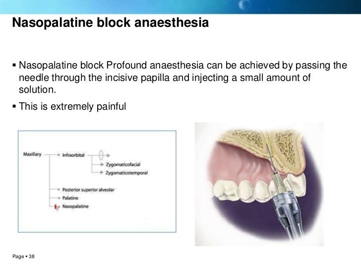 Local anesthesia Local anesthesia techniques