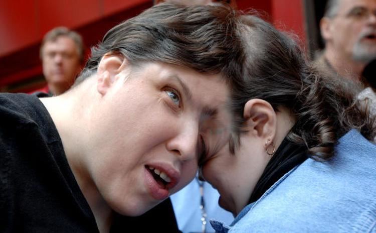 Lori and George Schappell, the oldest living conjoined twins.