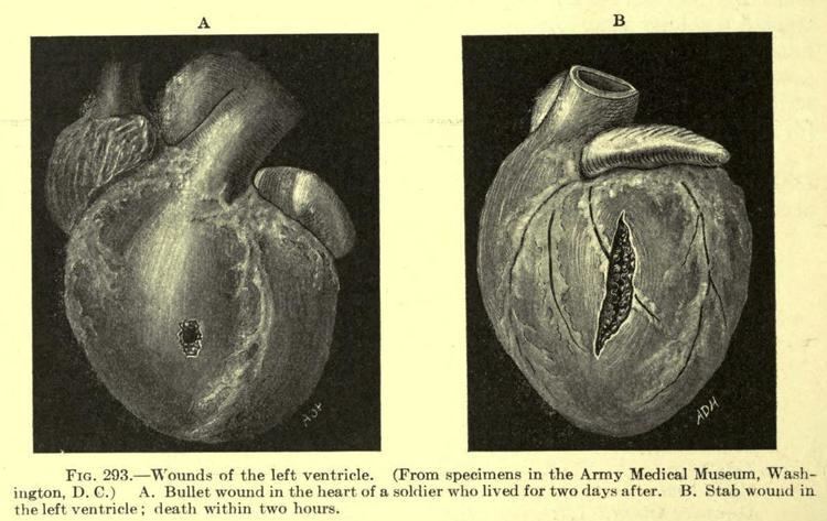 Ludwig Rehn Wounds of the Left Ventricle Left Bullet wound Biomedical