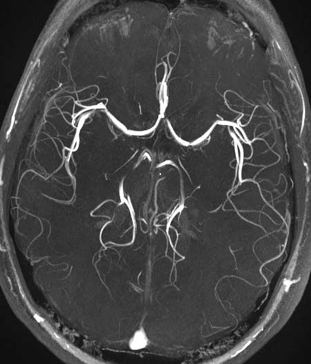 Magnetic resonance angiography