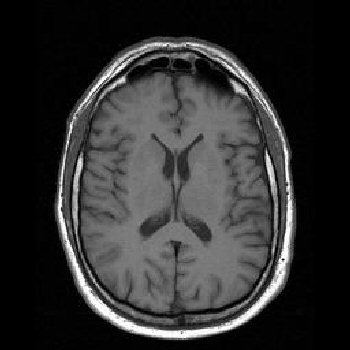 Magnetic resonance imaging of the brain MRI Images Brain MRI Images T1 MRTIPcom