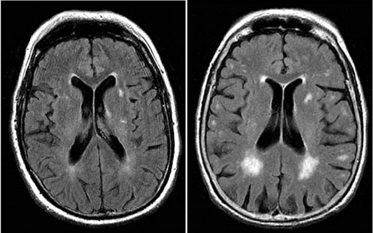 Magnetic resonance imaging of the brain Brain MRI White Matter Intensities Clinical Significance Brain Posts