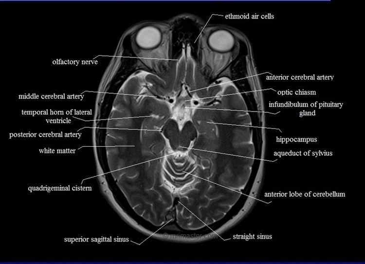 Magnetic resonance imaging of the brain MRI anatomy free MRI axial brain anatomy