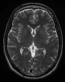 Magnetic resonance imaging of the brain Magnetic resonance imaging of the brain Wikipedia