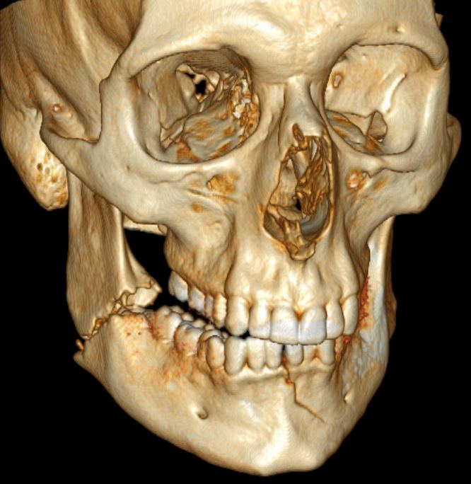 Mandibular fracture