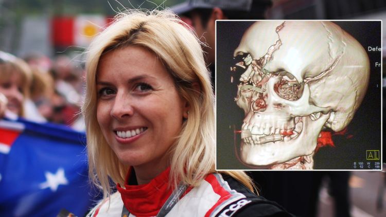 On the left, Maria de Villota smiling and wearing a white and red racing suit while on the right, a skull with a right eye injury