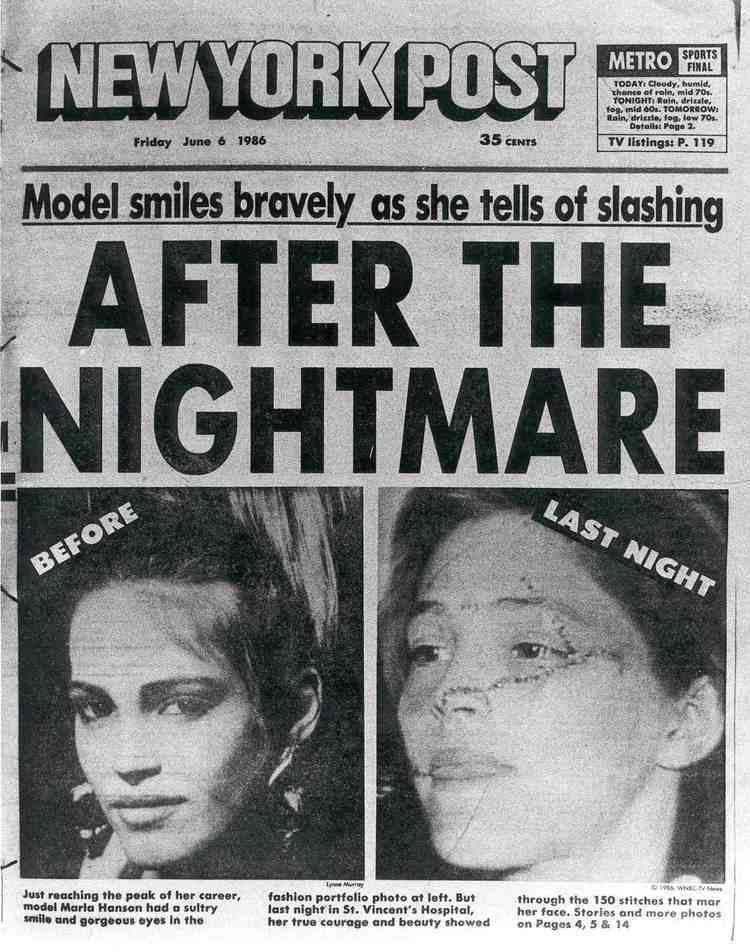 Marla Hanson featured in a newspaper with a beautiful face before and a scarred face a night after the slashing incident
