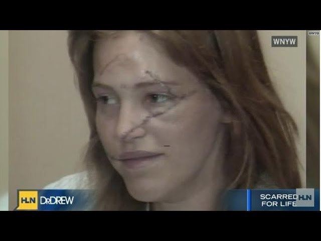 Marla Hanson flashed in a news with scars on her face