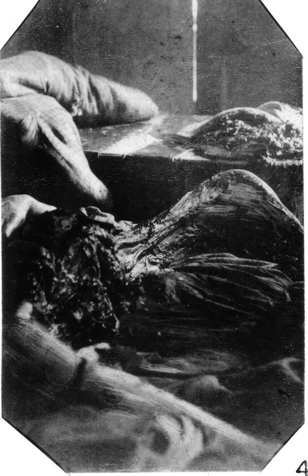Crime scene photograph of Mary Jane Kelly, depicting the mutilation inflicted to her lower abdomen, groin and thighs