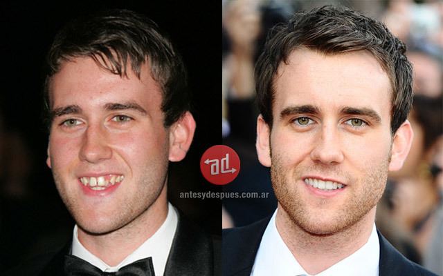Matthew Lewis (actor) Celebrity Teeth Before and After Before and After