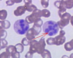 Megaloblastic anemia