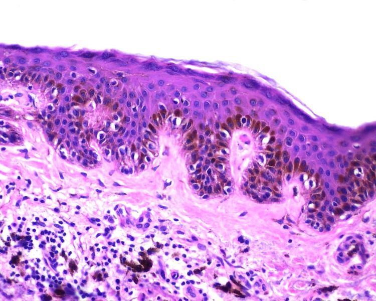 Melanocytic nevus