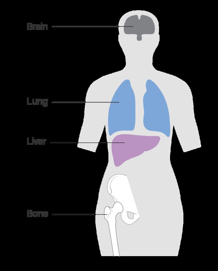 Metastatic breast cancer