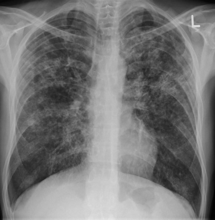 Miliary tuberculosis