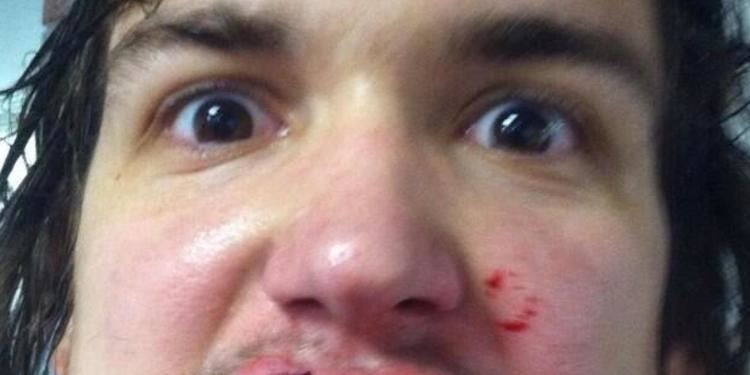 Mitch Callahan Mitch Callahan Grand Rapids Ice Hockey Player Hit By Puck To The