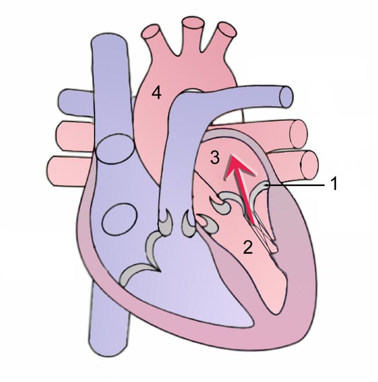 Mitral insufficiency