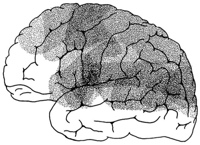 Mixed transcortical aphasia