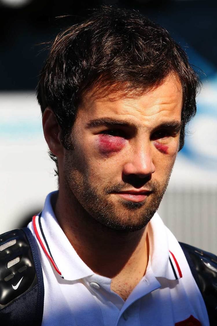 Morgan Parra France39s Morgan Parra sports two black eyes in the