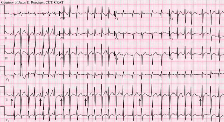 Multifocal atrial tachycardia