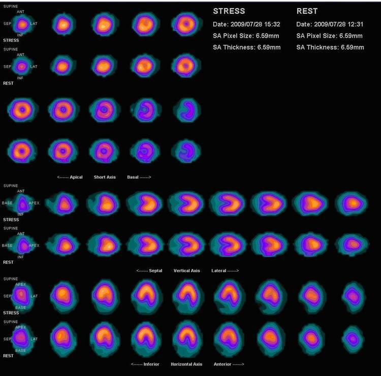 Myocardial perfusion imaging