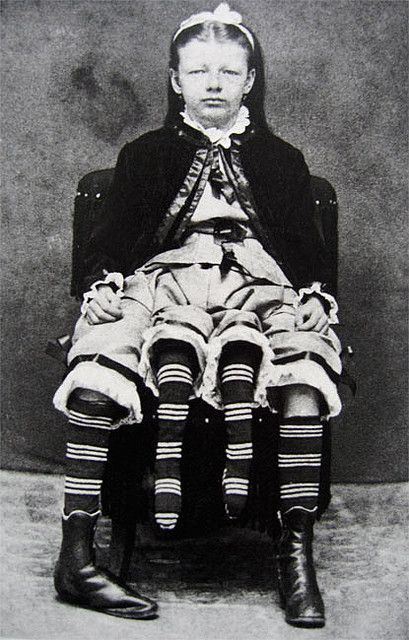 Myrtle Corbin as a girl sitting down with her Dipygus wearing a black dress along with striped socks and black boots and a headband.