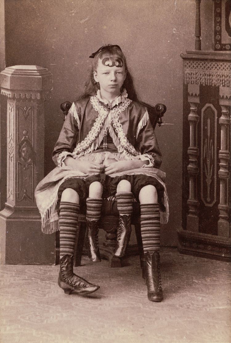 Myrtle Corbin, the four legged girl sitting down with her Dipygus wearing a black dress along with striped socks and black boots.
