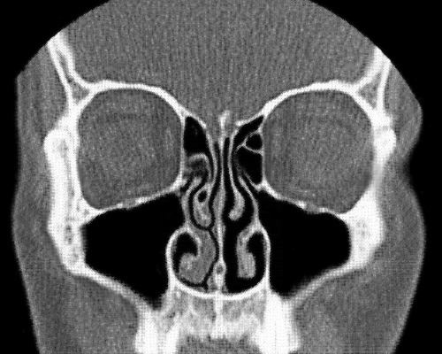 Nasal Cycle Alchetron The Free Social Encyclopedia