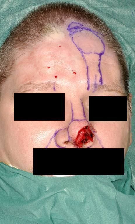 Nasal reconstruction using a paramedian forehead flap