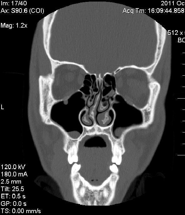 Nasal septum deviation