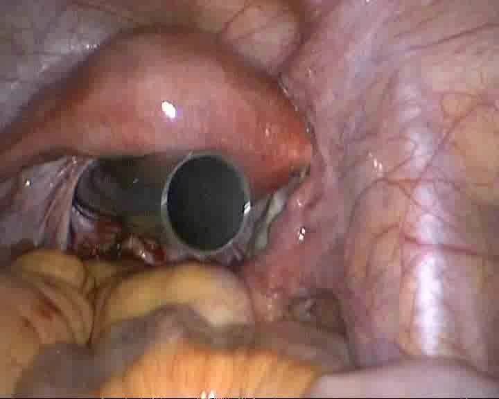Natural orifice translumenal endoscopic surgery