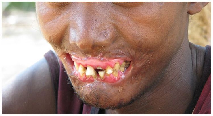 Necrotizing periodontal diseases