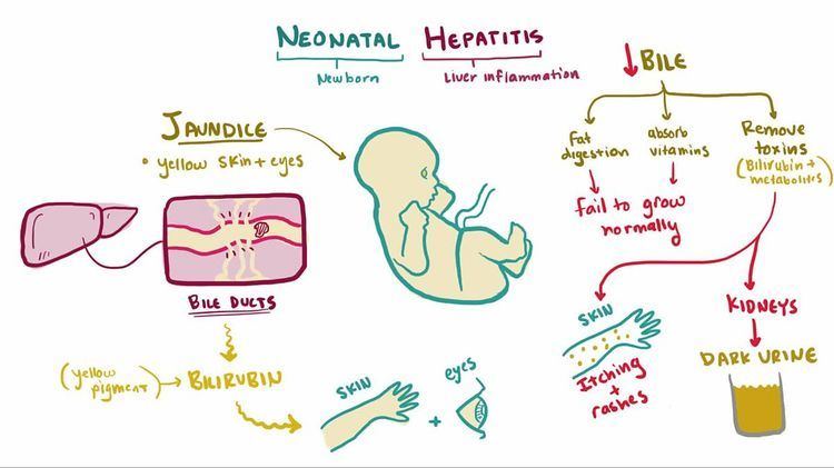 Neonatal hepatitis