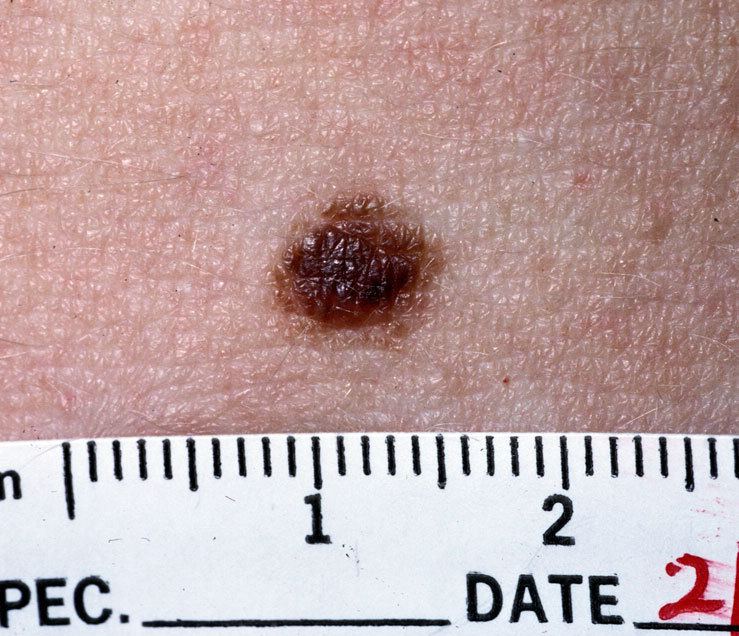 Nevus