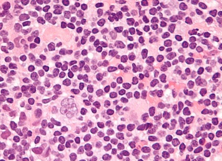 Nodular lymphocyte predominant Hodgkin's lymphoma
